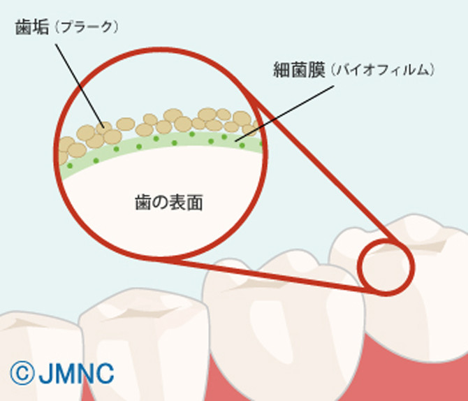 虫歯の治療について