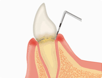 歯周ポケット検査