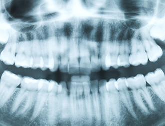 歯の動揺度の検査