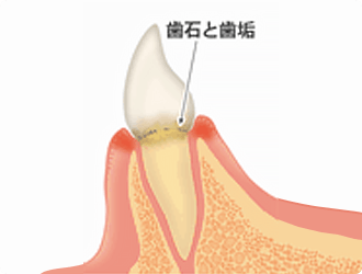 初期段階：歯肉炎