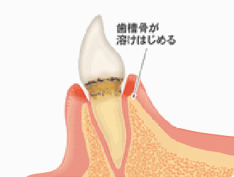 中期段階：軽度歯周炎