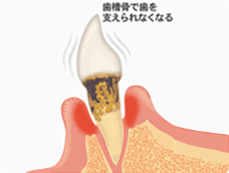 末期段階：重度歯周炎